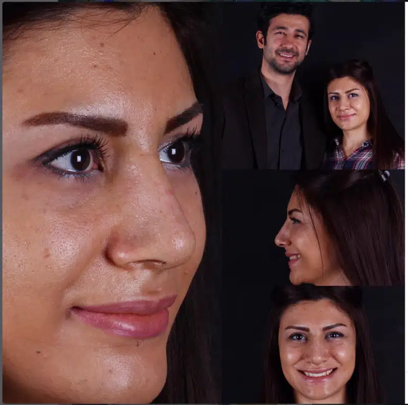 Suleyman Tas reviews – verified rhinoplasty patient review #349
