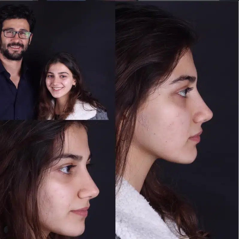 Suleyman Tas reviews – verified rhinoplasty patient review #275