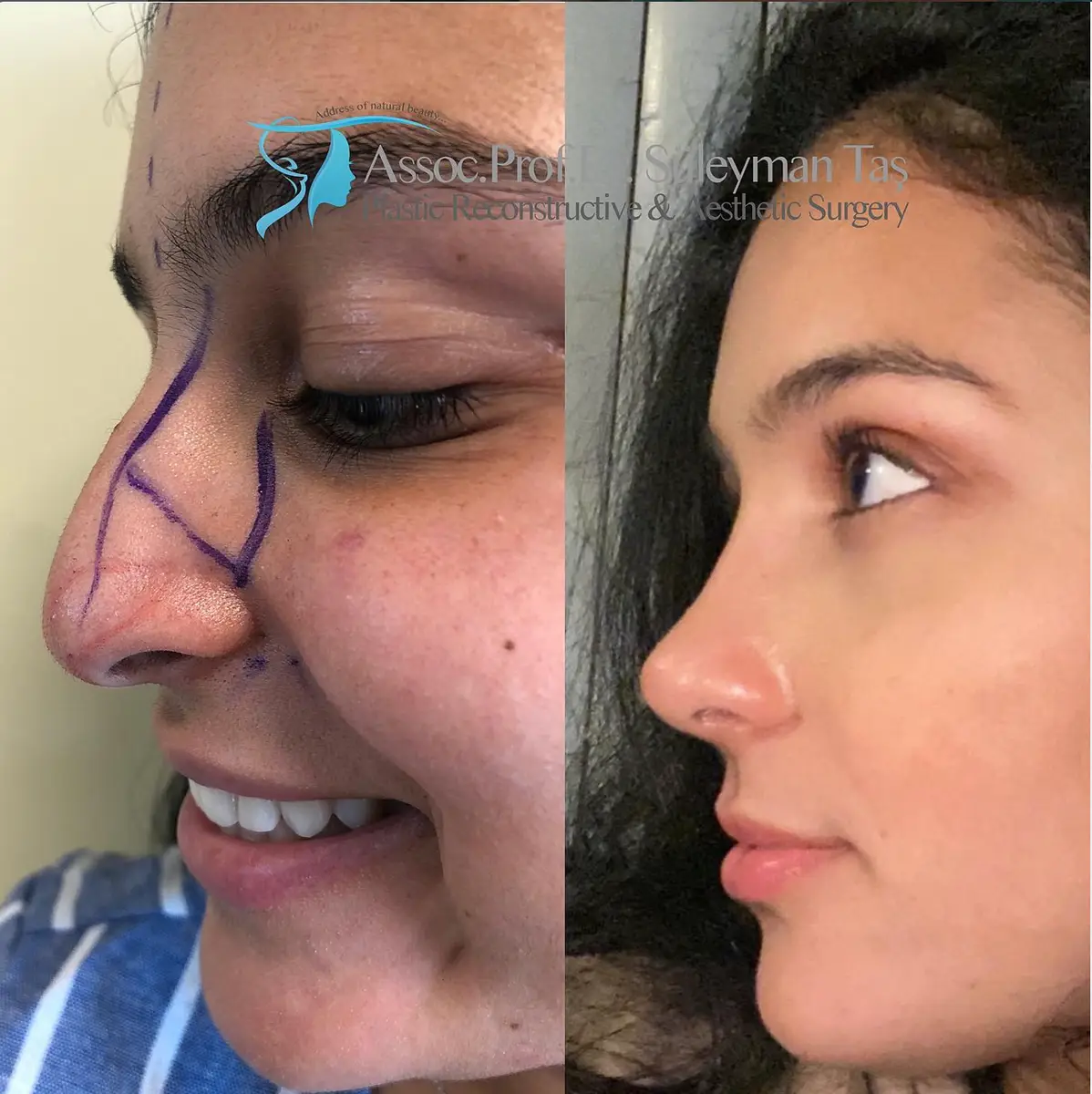 Suleyman Tas reviews – verified rhinoplasty patient review #164 (photo 1)