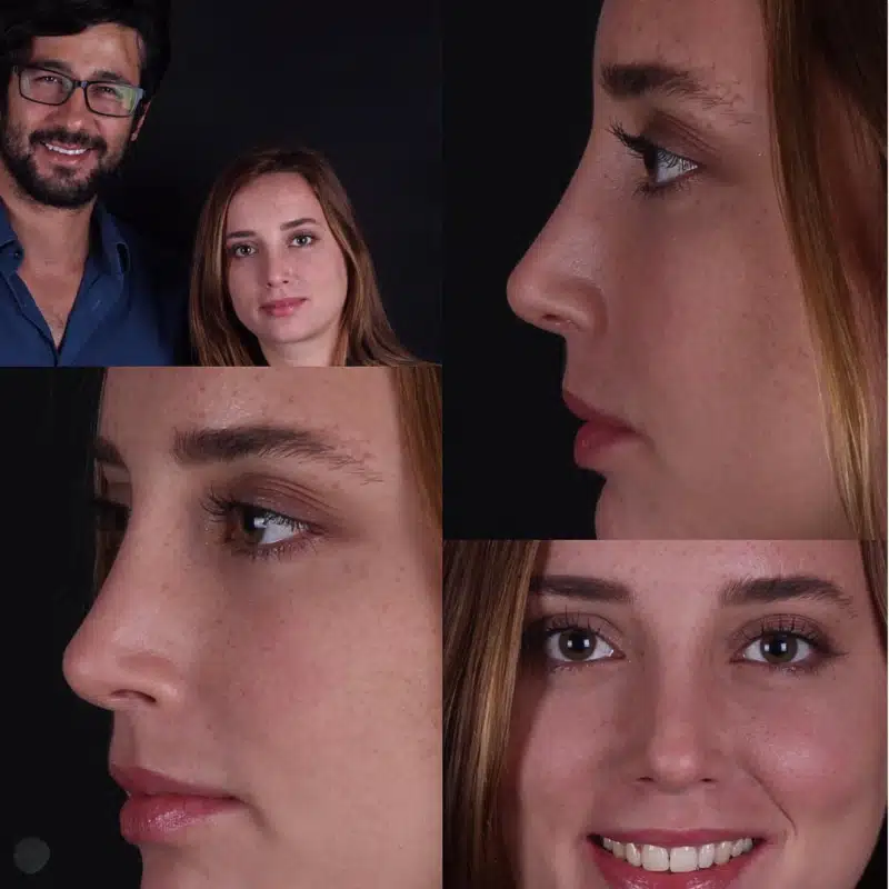 Suleyman Tas reviews – verified rhinoplasty patient review #296