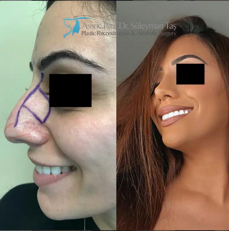 Suleyman Tas reviews – verified rhinoplasty patient review #190 (photo 2)