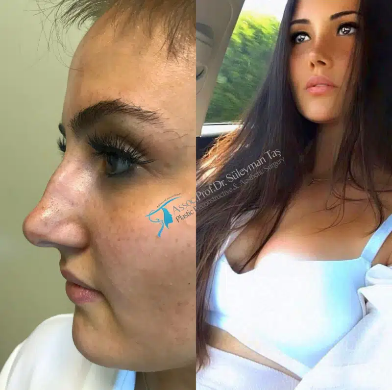 Suleyman Tas reviews – verified rhinoplasty patient review #169 (photo 2)