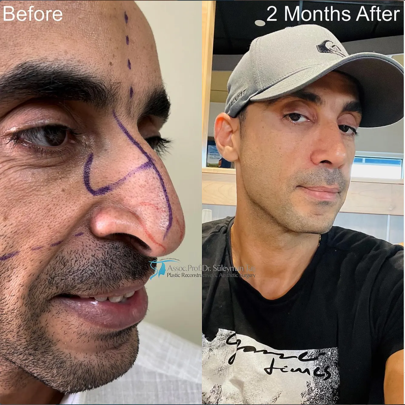 Suleyman Tas reviews – verified rhinoplasty patient review #60 (photo 1)