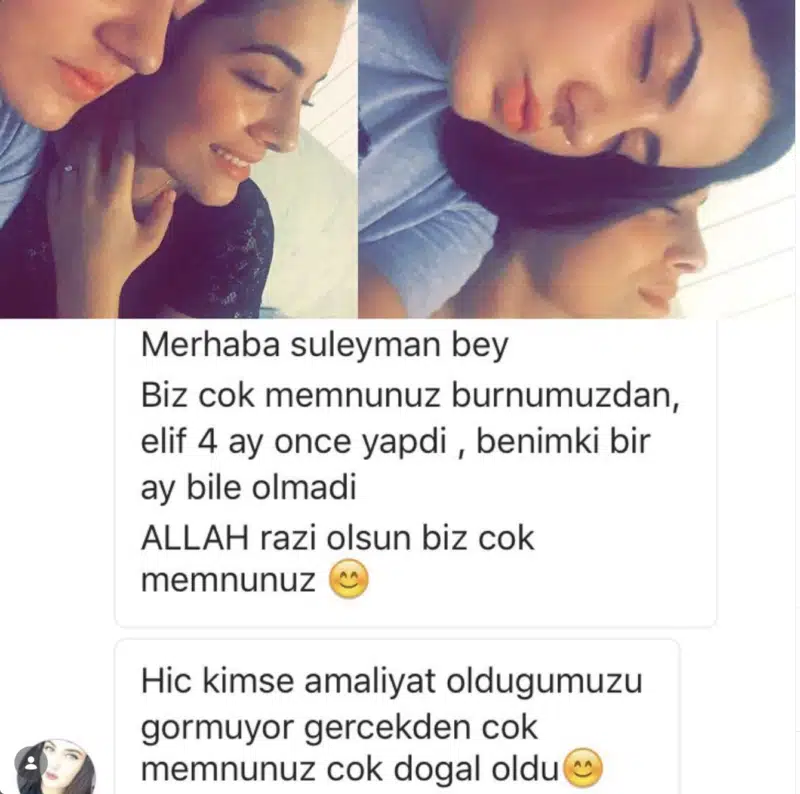 Suleyman Tas reviews – verified rhinoplasty patient review #289
