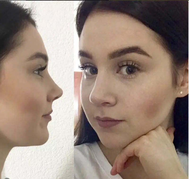 Suleyman Tas reviews – verified rhinoplasty patient review #229