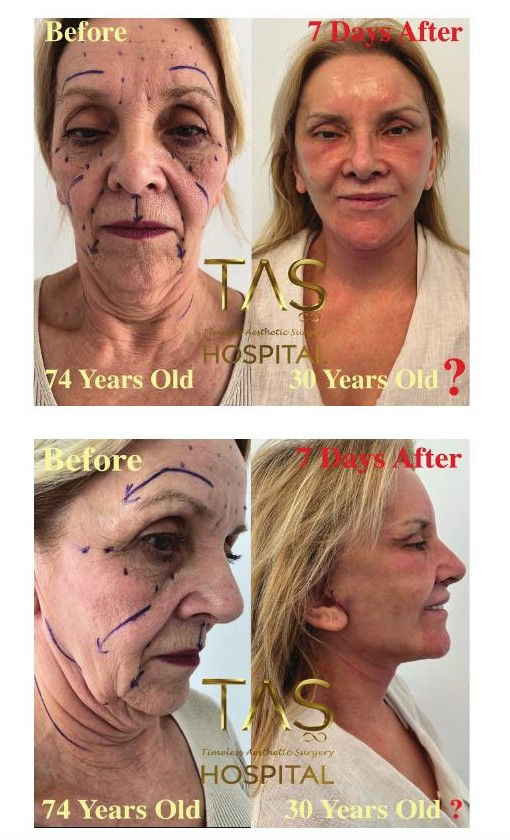 Facelift Surgery Guide 2026: What to Know Before You Book