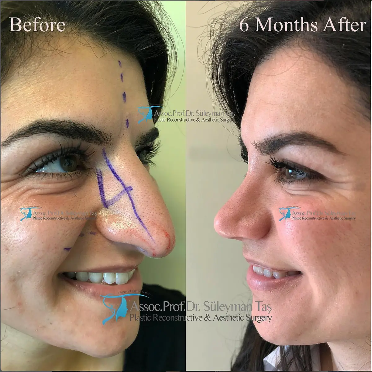 Suleyman Tas reviews – verified rhinoplasty patient review #141