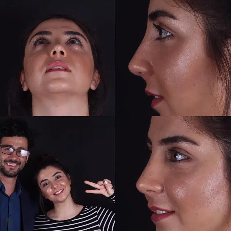 Suleyman Tas reviews – verified rhinoplasty patient review #318