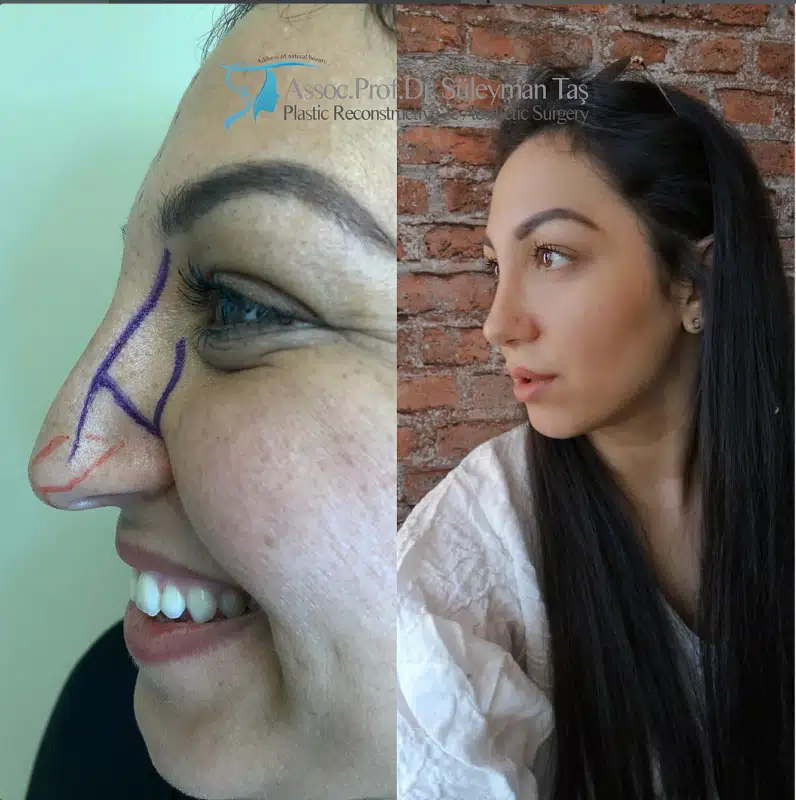 Suleyman Tas reviews – verified rhinoplasty patient review #183 (photo 1)