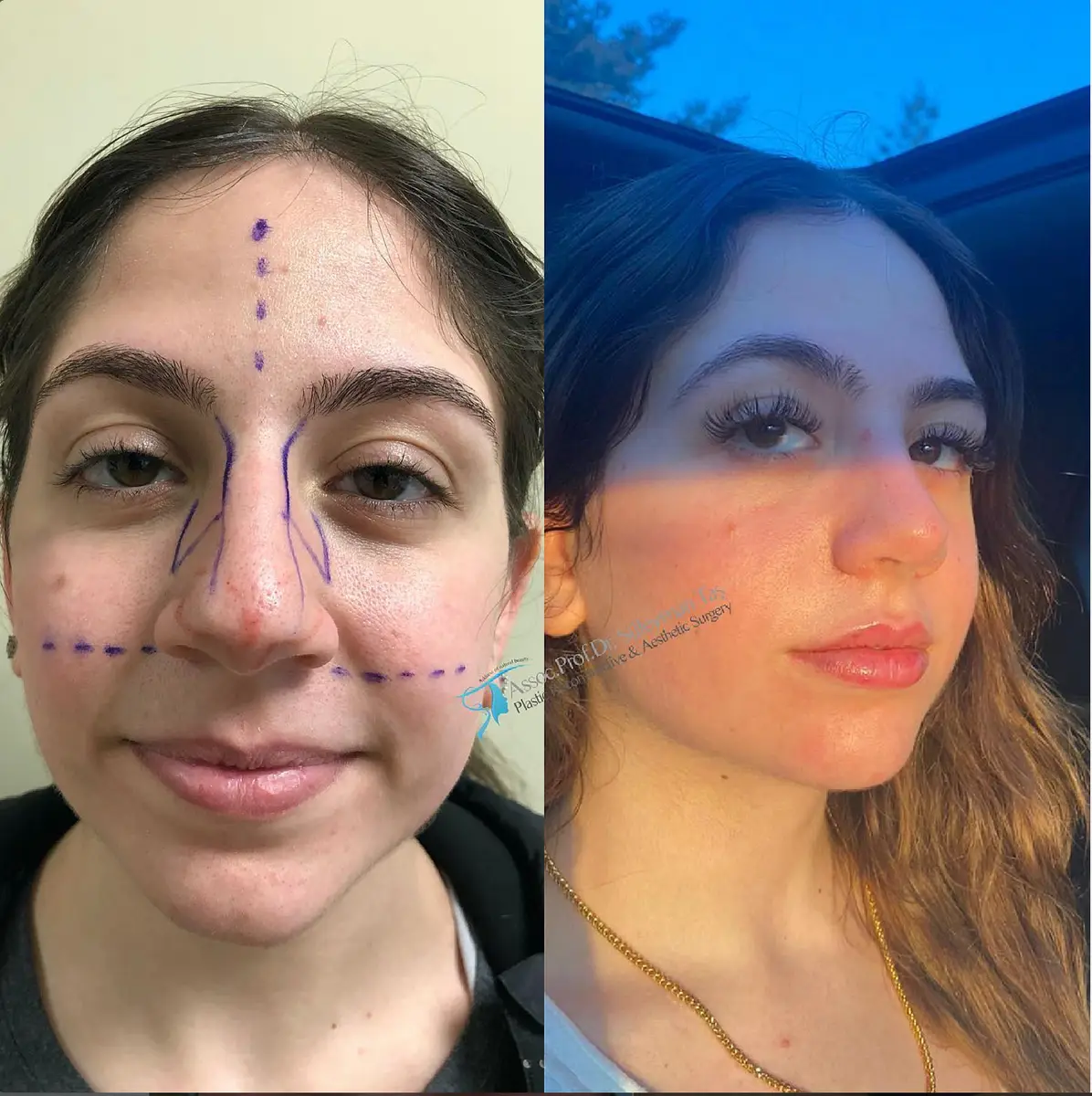 Suleyman Tas reviews – verified rhinoplasty patient review #133 (photo 3)
