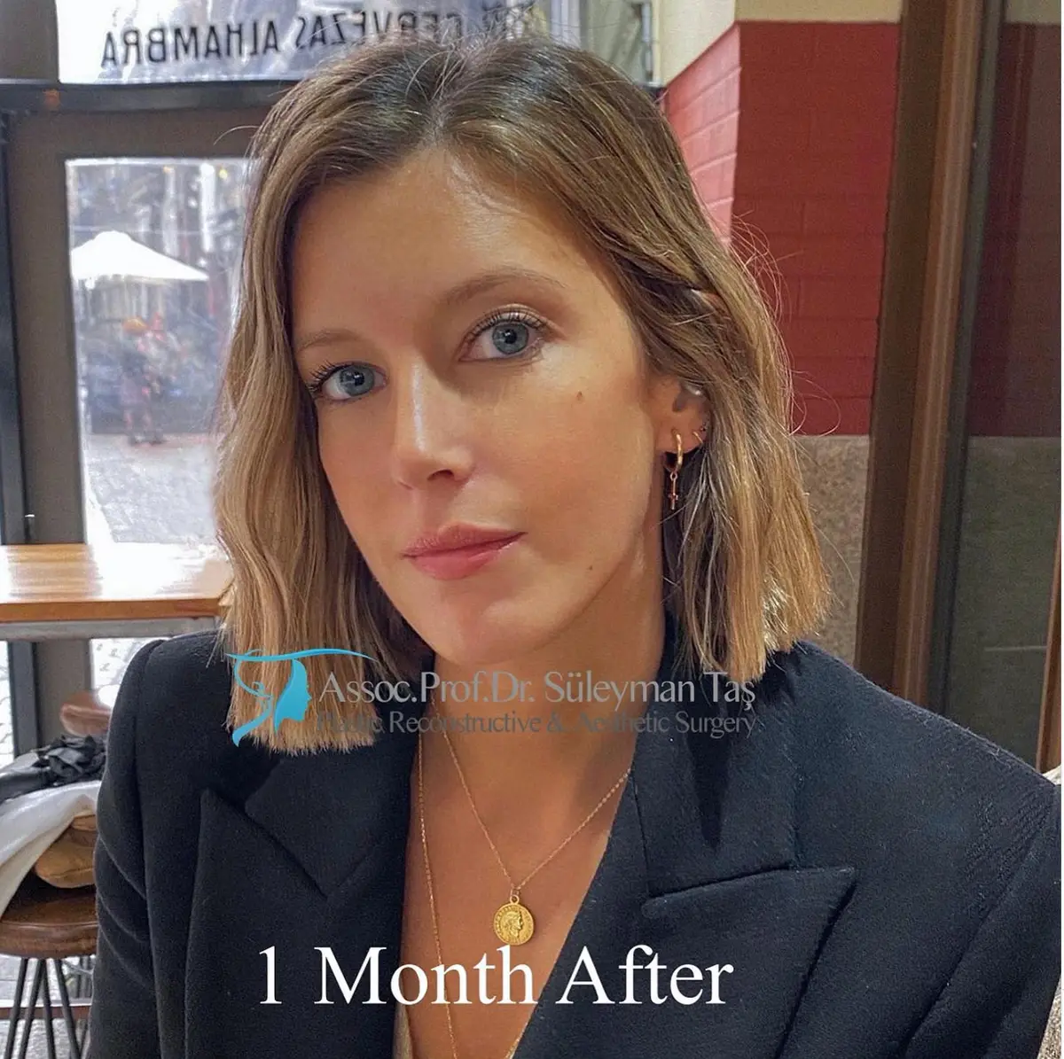 Suleyman Tas reviews – verified rhinoplasty patient review #99 (photo 1)
