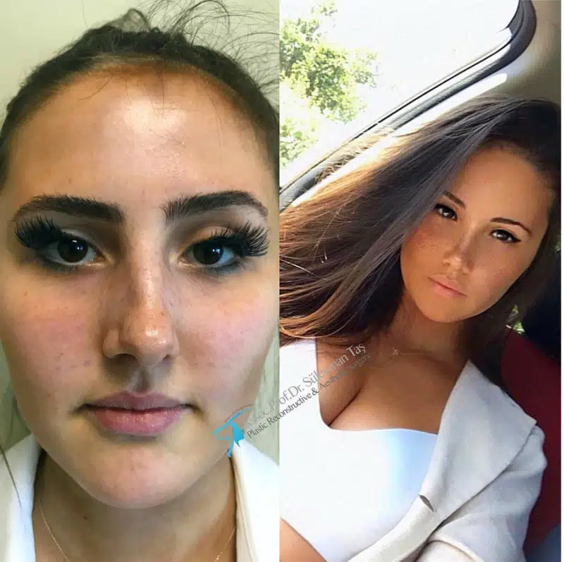 Suleyman Tas reviews – verified rhinoplasty patient review #169 (photo 1)