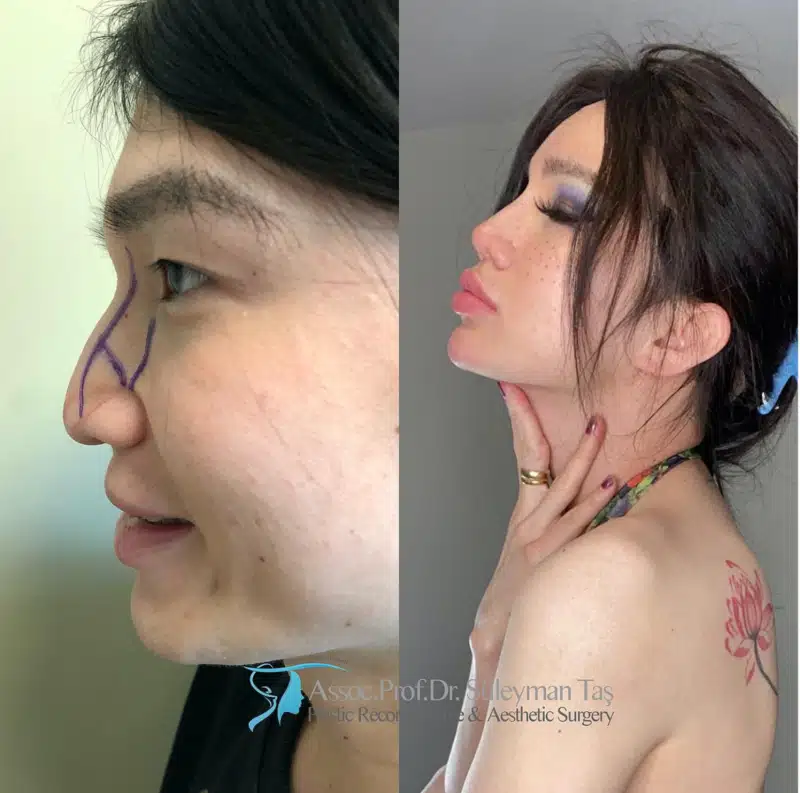 Suleyman Tas reviews – verified rhinoplasty patient review #185 (photo 4)