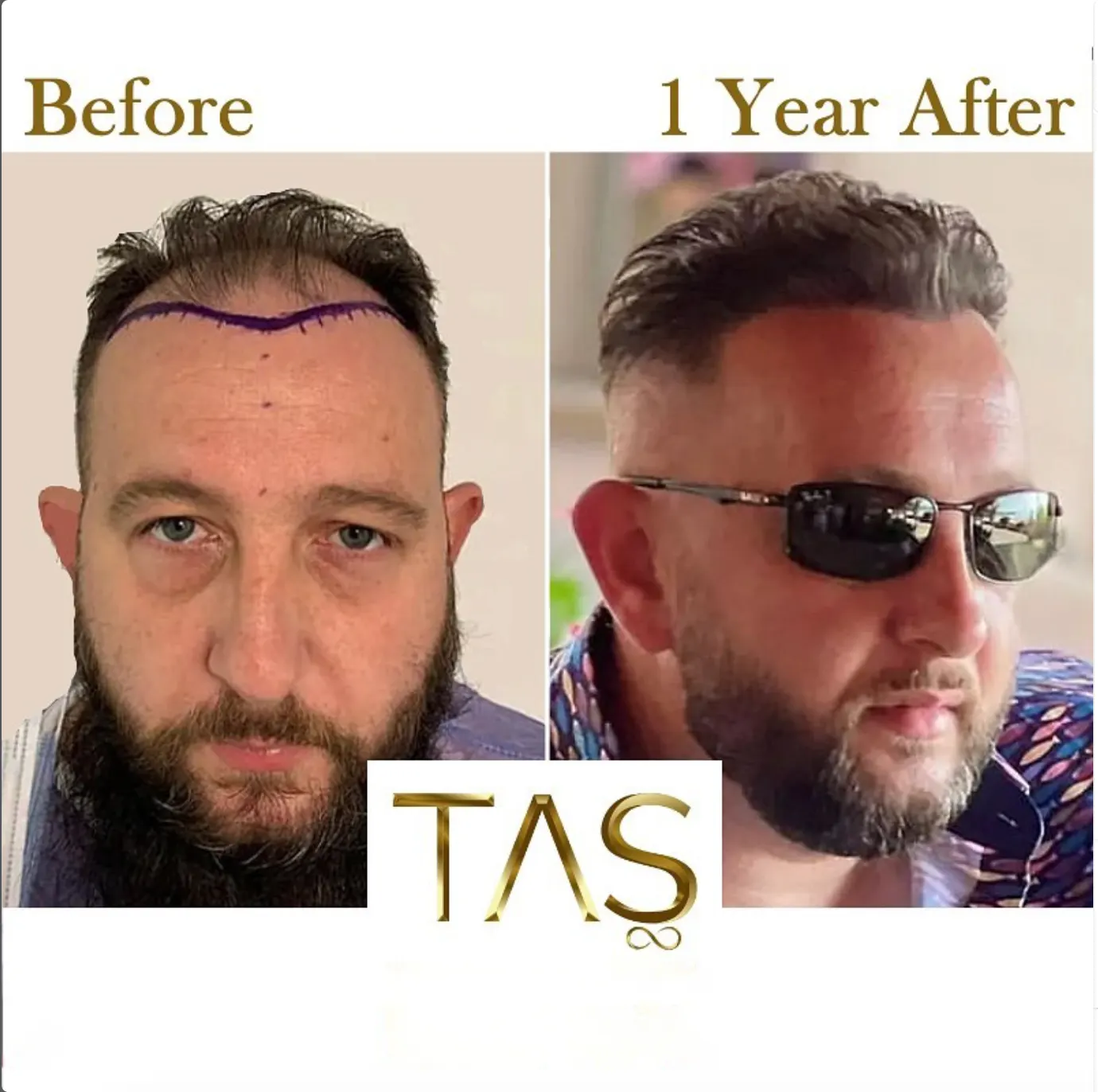 Suleyman Tas reviews – verified hair transplant patient review #51
