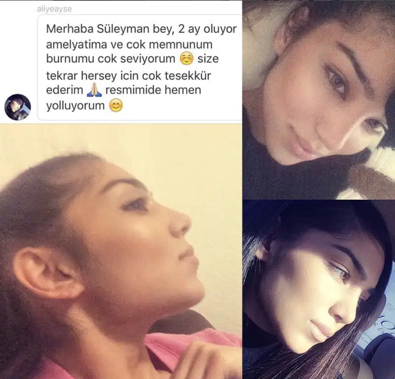 Suleyman Tas reviews – verified rhinoplasty patient review #336