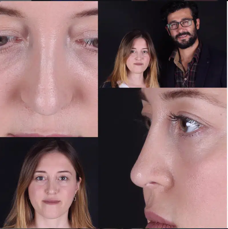 Suleyman Tas reviews – verified rhinoplasty patient review #281