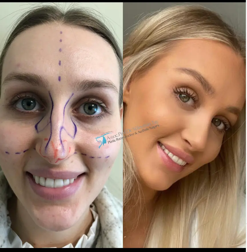 Suleyman Tas reviews – verified rhinoplasty patient review #134 (photo 2)