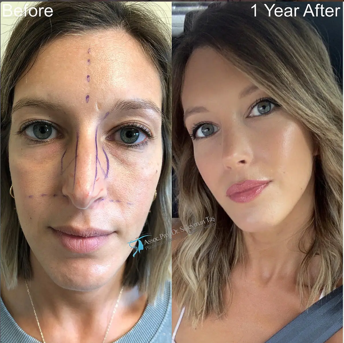 Suleyman Tas reviews – verified rhinoplasty patient review #99 (photo 3)