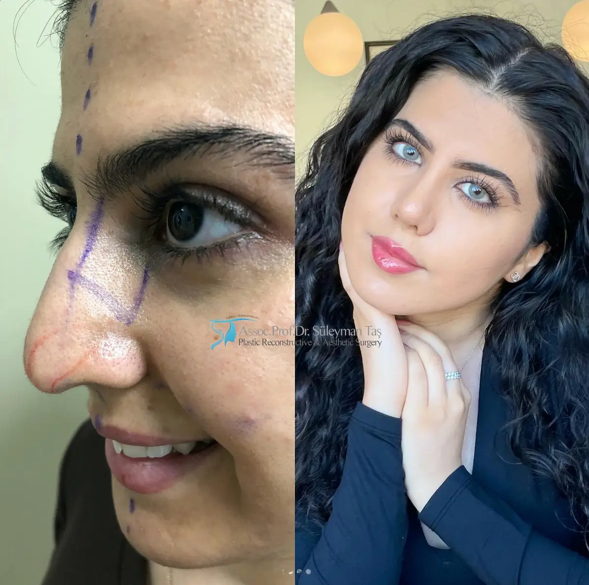 Suleyman Tas reviews – verified rhinoplasty patient review #147
