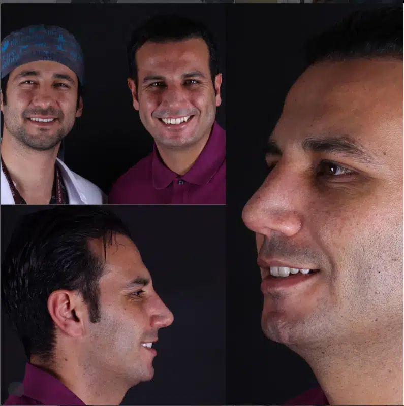 Suleyman Tas reviews – verified rhinoplasty patient review #353