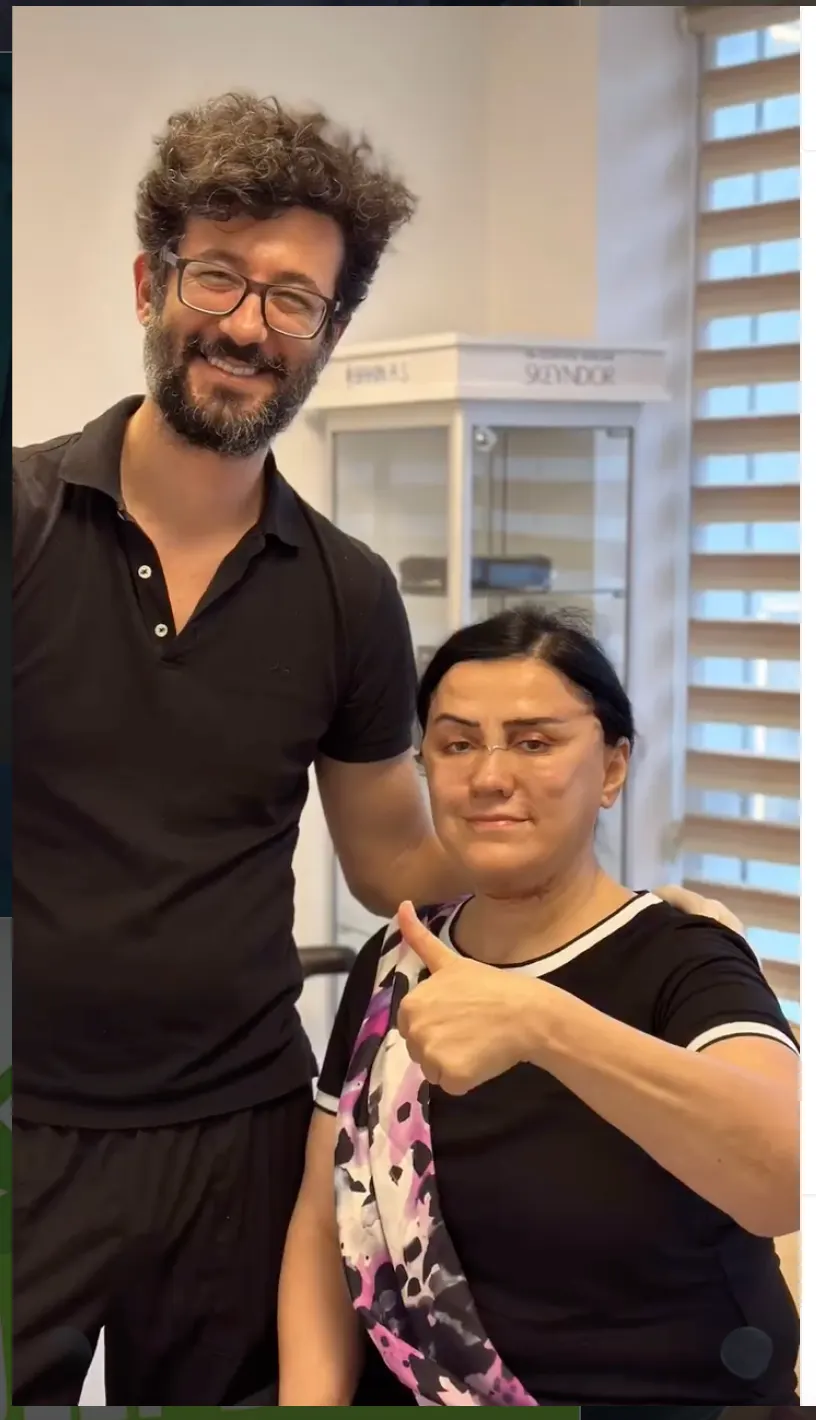 Suleyman Tas reviews – verified facelift patient review #39