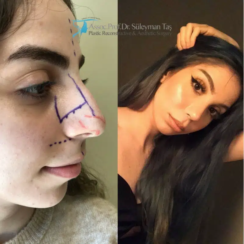Suleyman Tas reviews – verified rhinoplasty patient review #181 (photo 1)