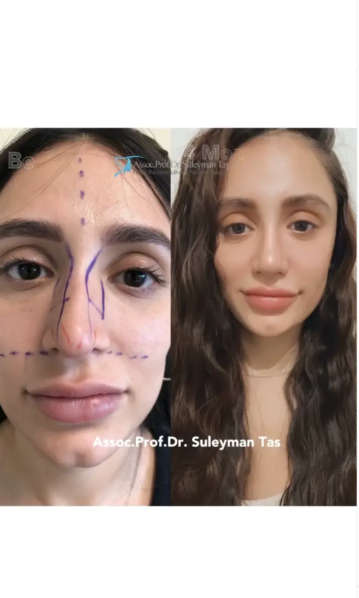 Suleyman Tas reviews – verified rhinoplasty patient review #151 (photo 2)
