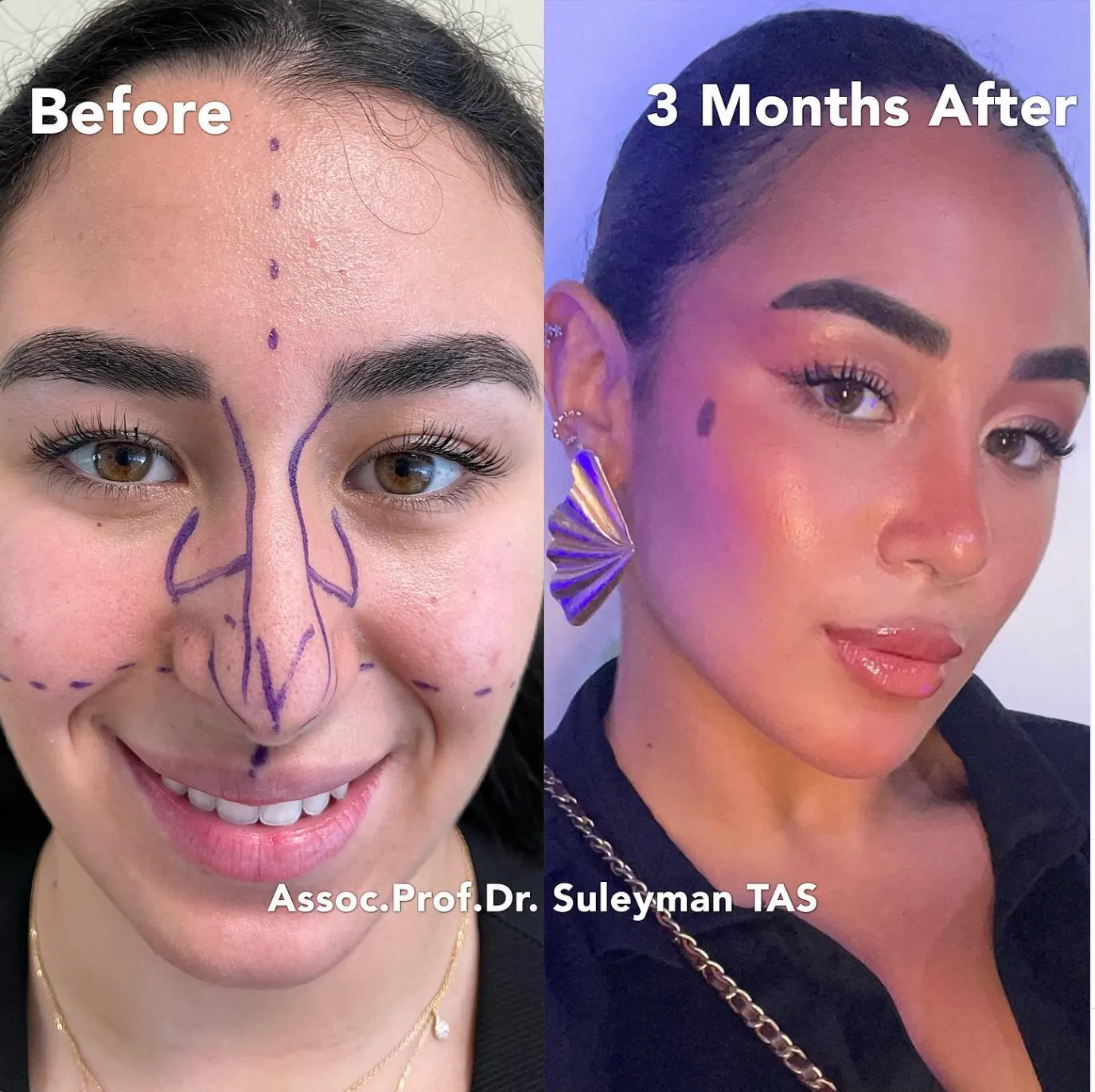 Suleyman Tas reviews – verified rhinoplasty patient review #55