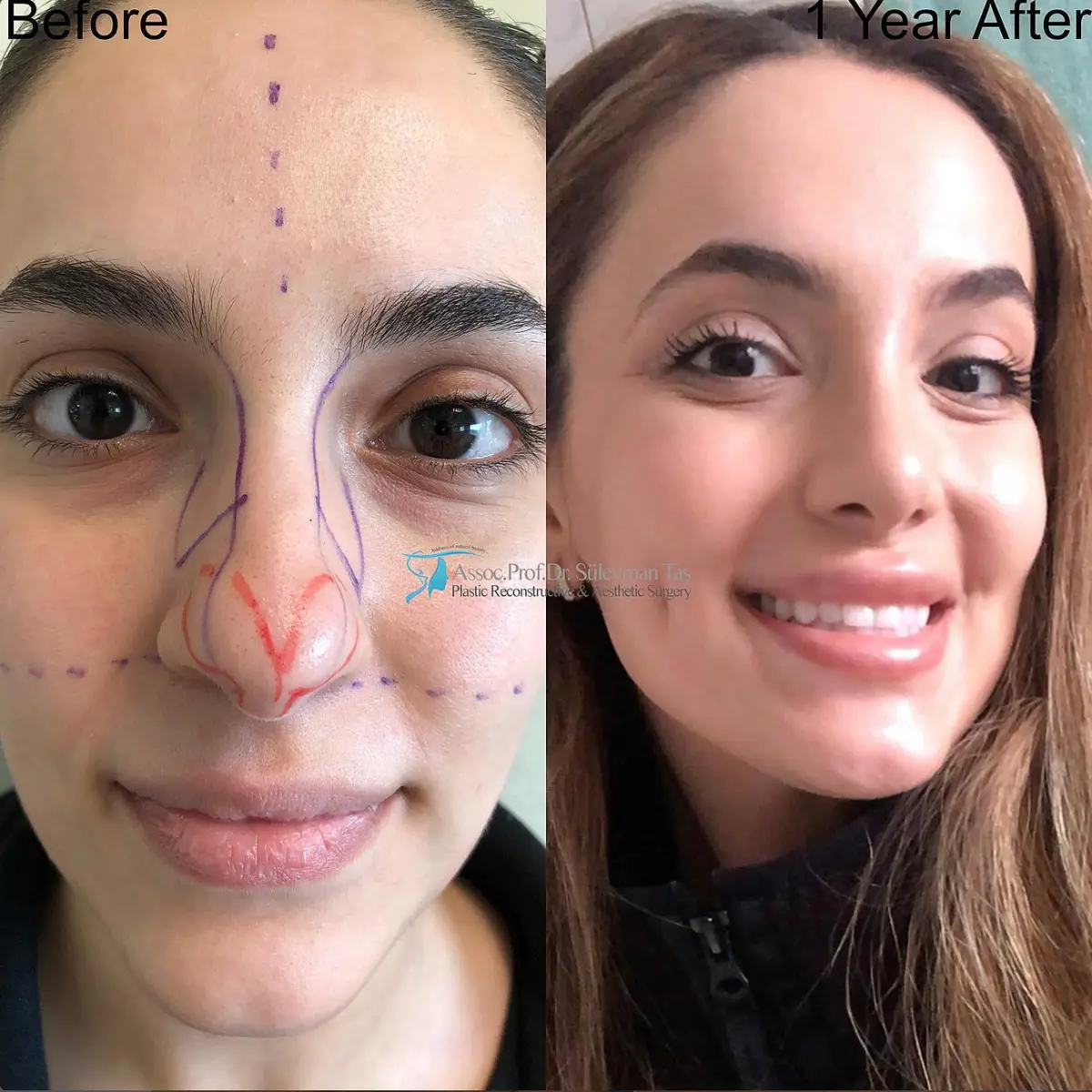Suleyman Tas reviews – verified rhinoplasty patient review #94