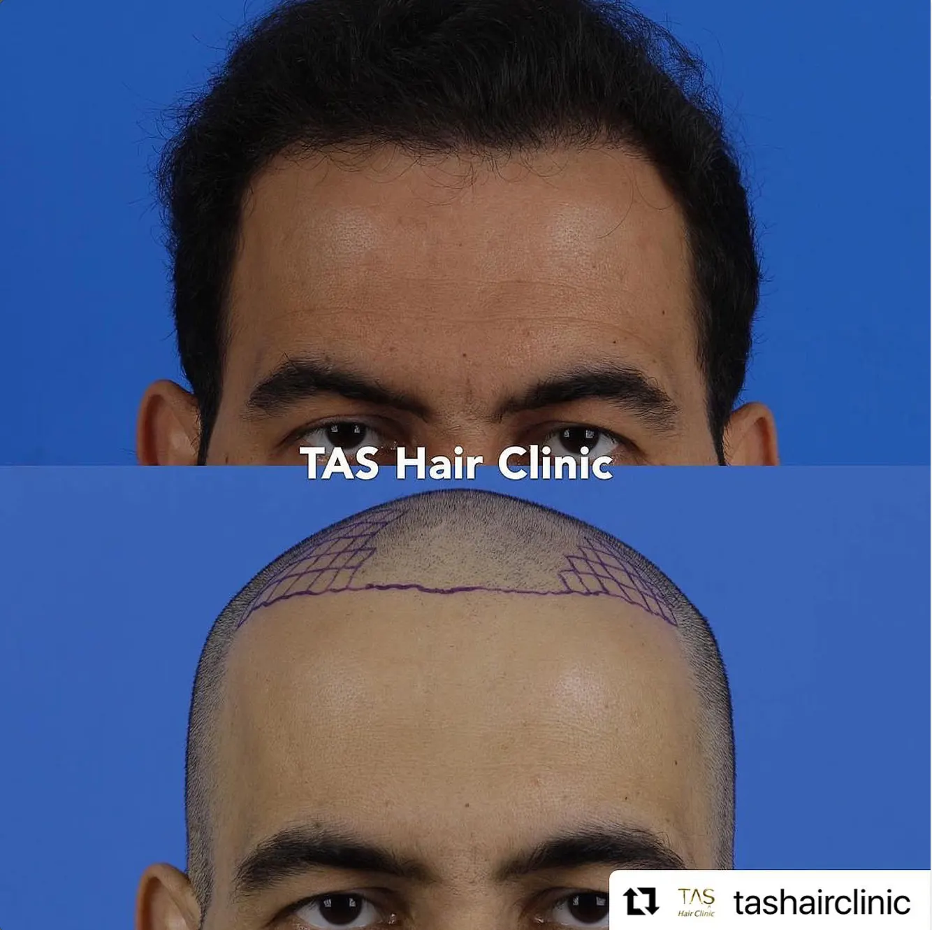 Suleyman Tas reviews – verified hair transplant patient review #56 (photo 2)