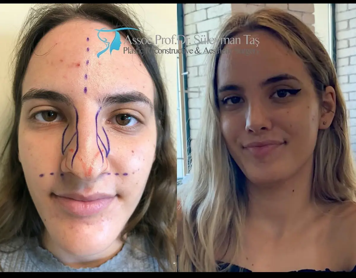 Suleyman Tas reviews – verified rhinoplasty patient review #163 (photo 1)