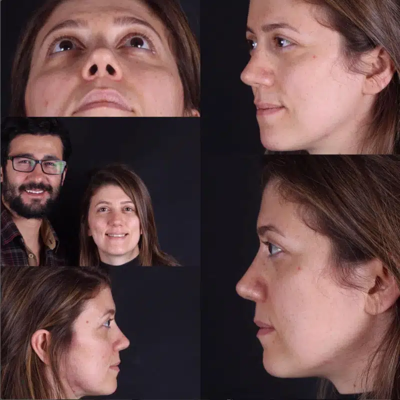 Suleyman Tas reviews – verified rhinoplasty patient review #272