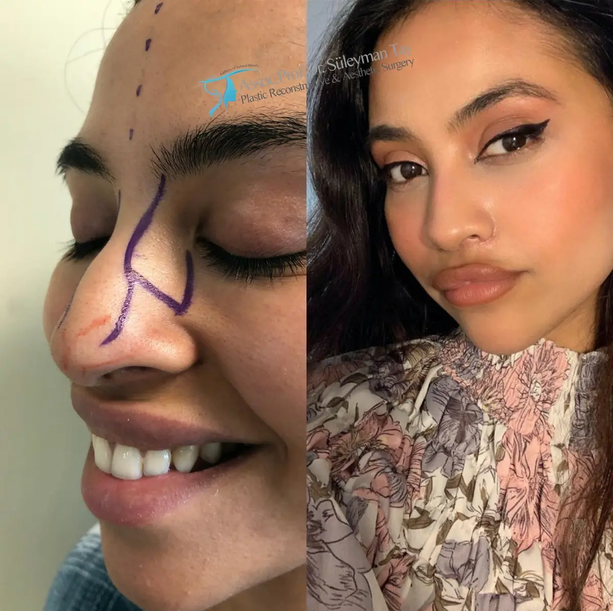 Suleyman Tas reviews – verified rhinoplasty patient review #159 (photo 2)