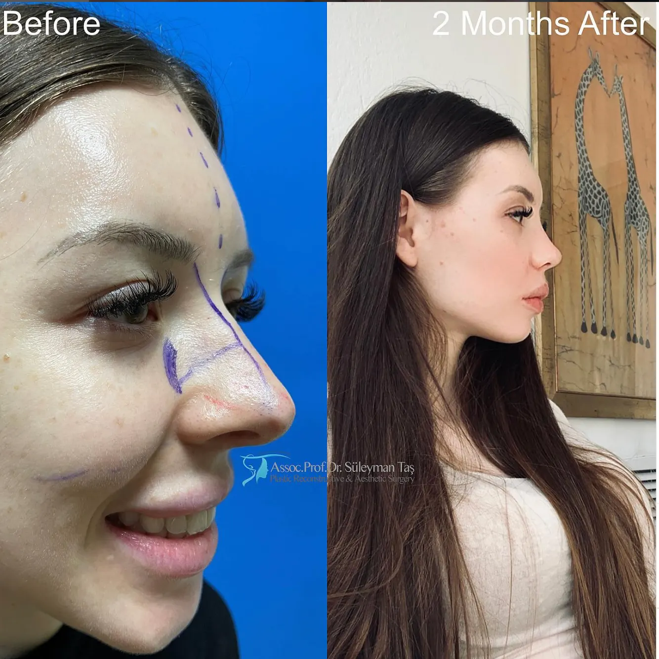 Suleyman Tas reviews – verified rhinoplasty patient review #59