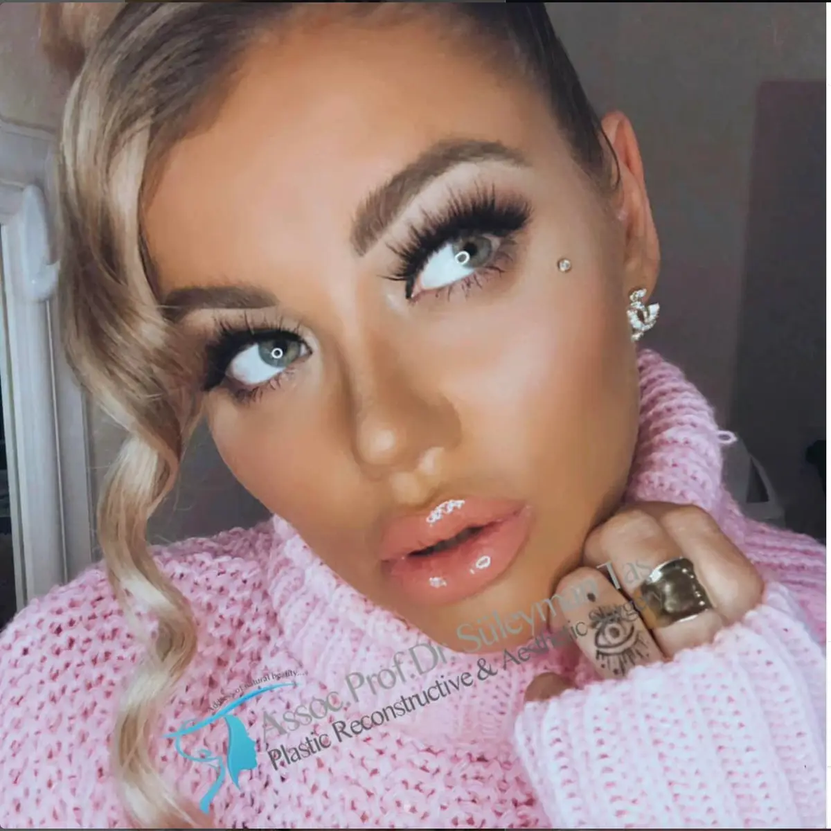 Suleyman Tas reviews – verified rhinoplasty patient review #150 (photo 2)