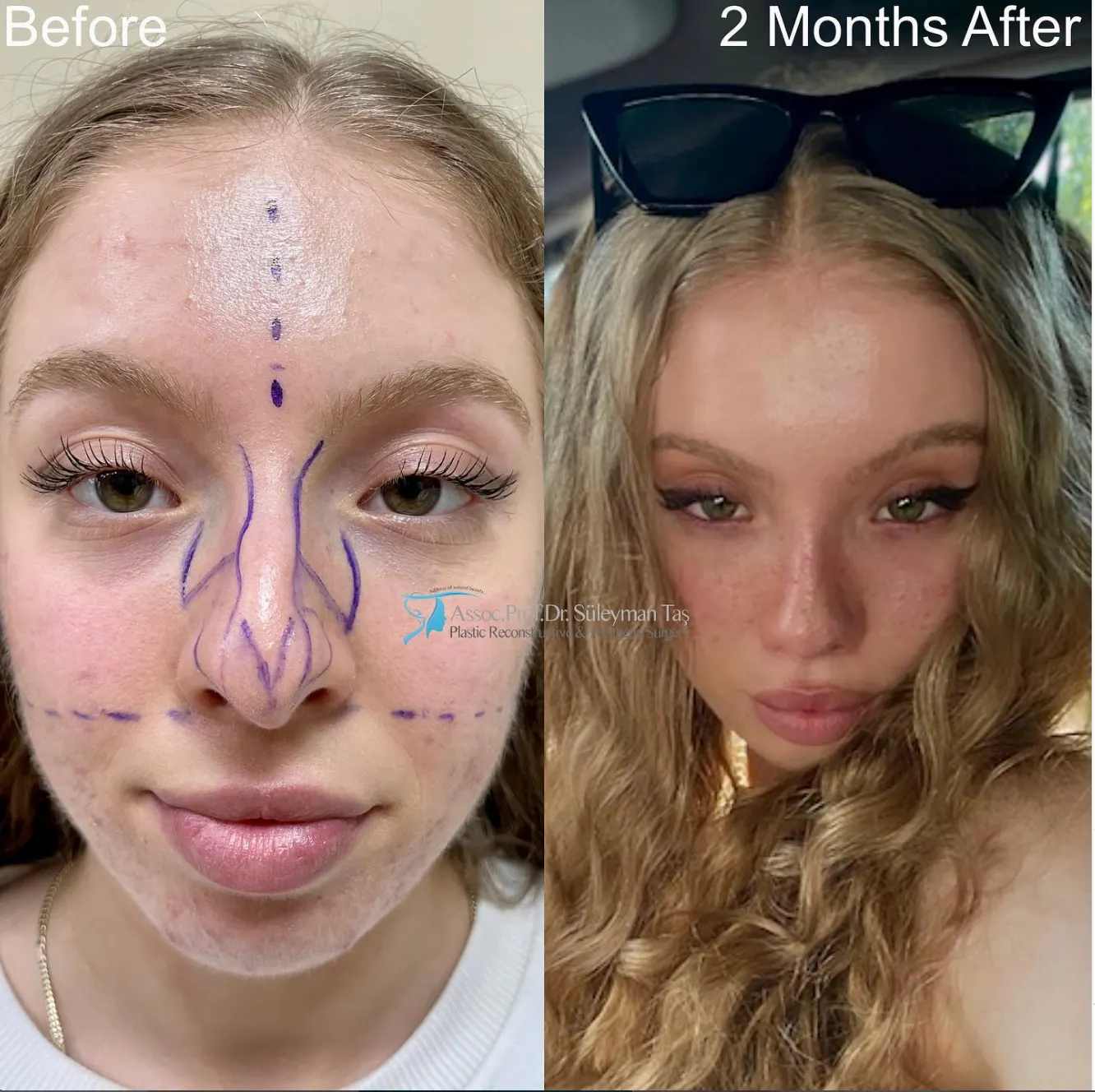 Suleyman Tas reviews – verified rhinoplasty patient review #62 (photo 1)