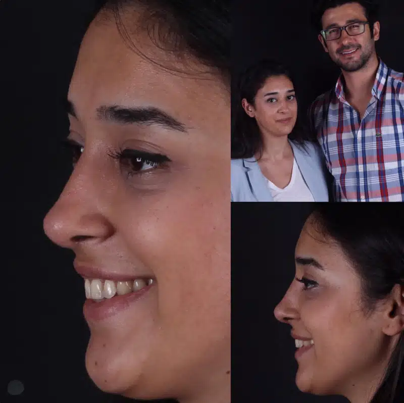 Suleyman Tas reviews – verified rhinoplasty patient review #309