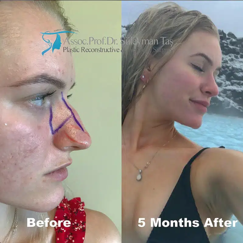 Suleyman Tas reviews – verified rhinoplasty patient review #189 (photo 1)