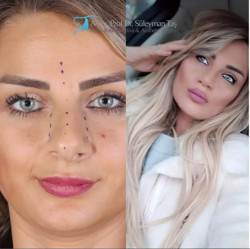 Suleyman Tas reviews – verified rhinoplasty patient review #175 (photo 1)