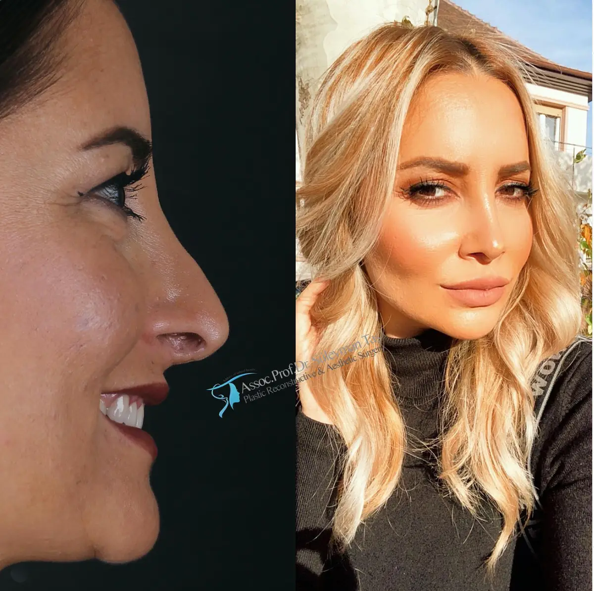 Suleyman Tas reviews – verified rhinoplasty patient review #138 (photo 1)
