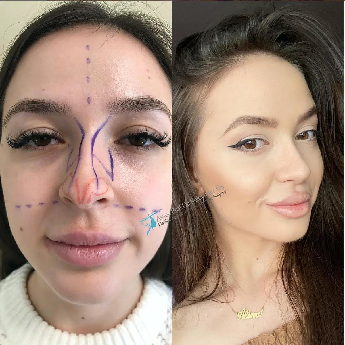 Suleyman Tas reviews – verified rhinoplasty patient review #132 (photo 1)