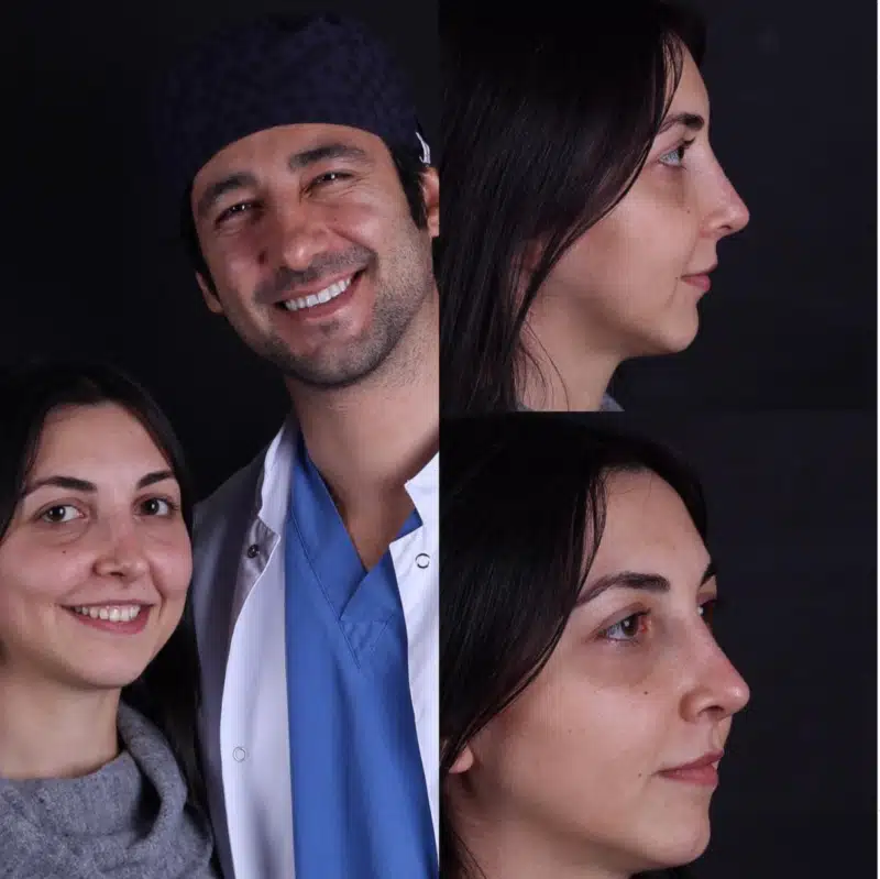 Suleyman Tas reviews – verified rhinoplasty patient review #369