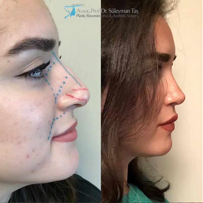 Suleyman Tas reviews – verified rhinoplasty patient review #172 (photo 2)