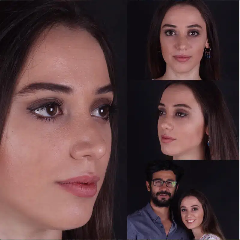 Suleyman Tas reviews – verified rhinoplasty patient review #303