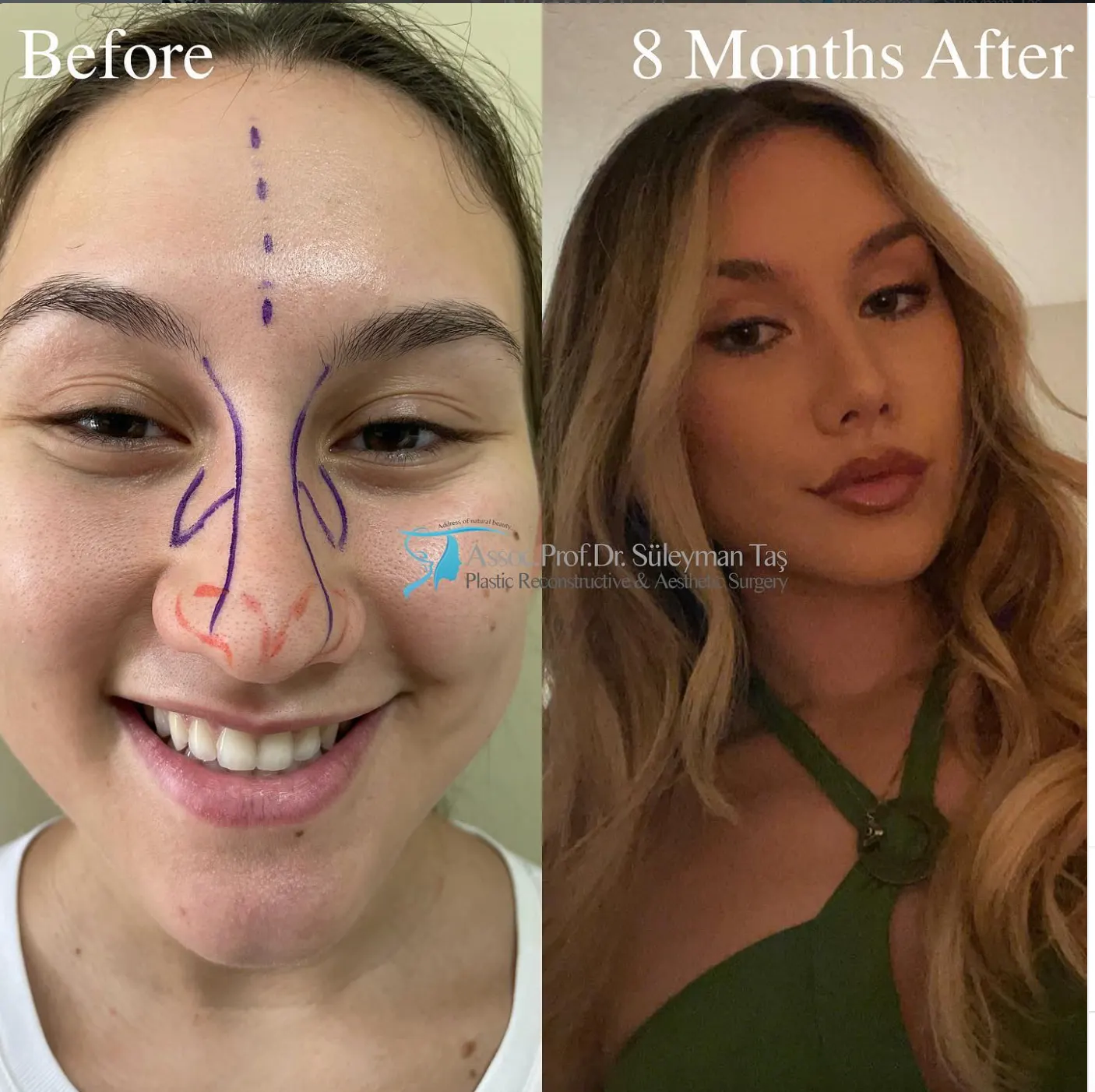 Suleyman Tas reviews – verified rhinoplasty patient review #72