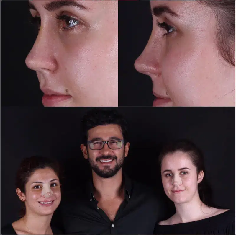 Suleyman Tas reviews – verified rhinoplasty patient review #292