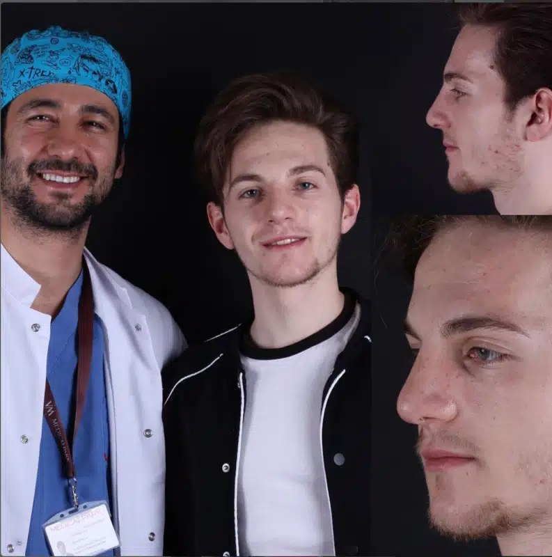 Suleyman Tas reviews – verified rhinoplasty patient review #346
