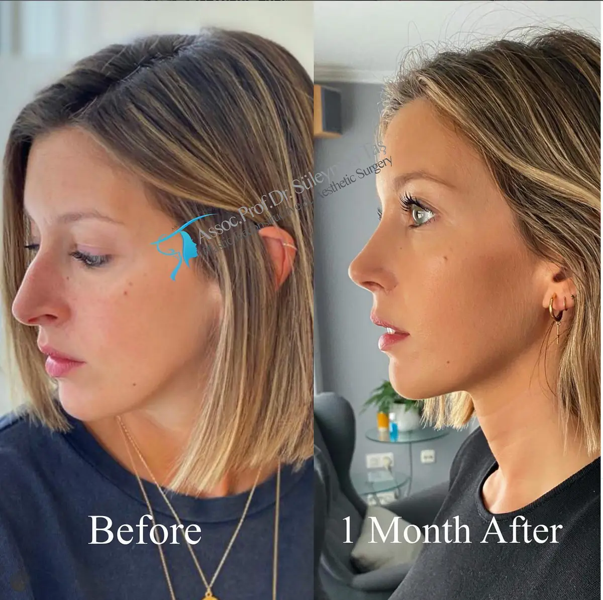 Suleyman Tas reviews – verified rhinoplasty patient review #99 (photo 2)