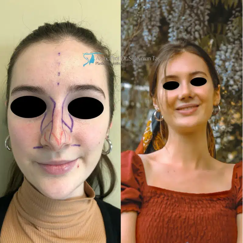 Suleyman Tas reviews – verified rhinoplasty patient review #171 (photo 1)