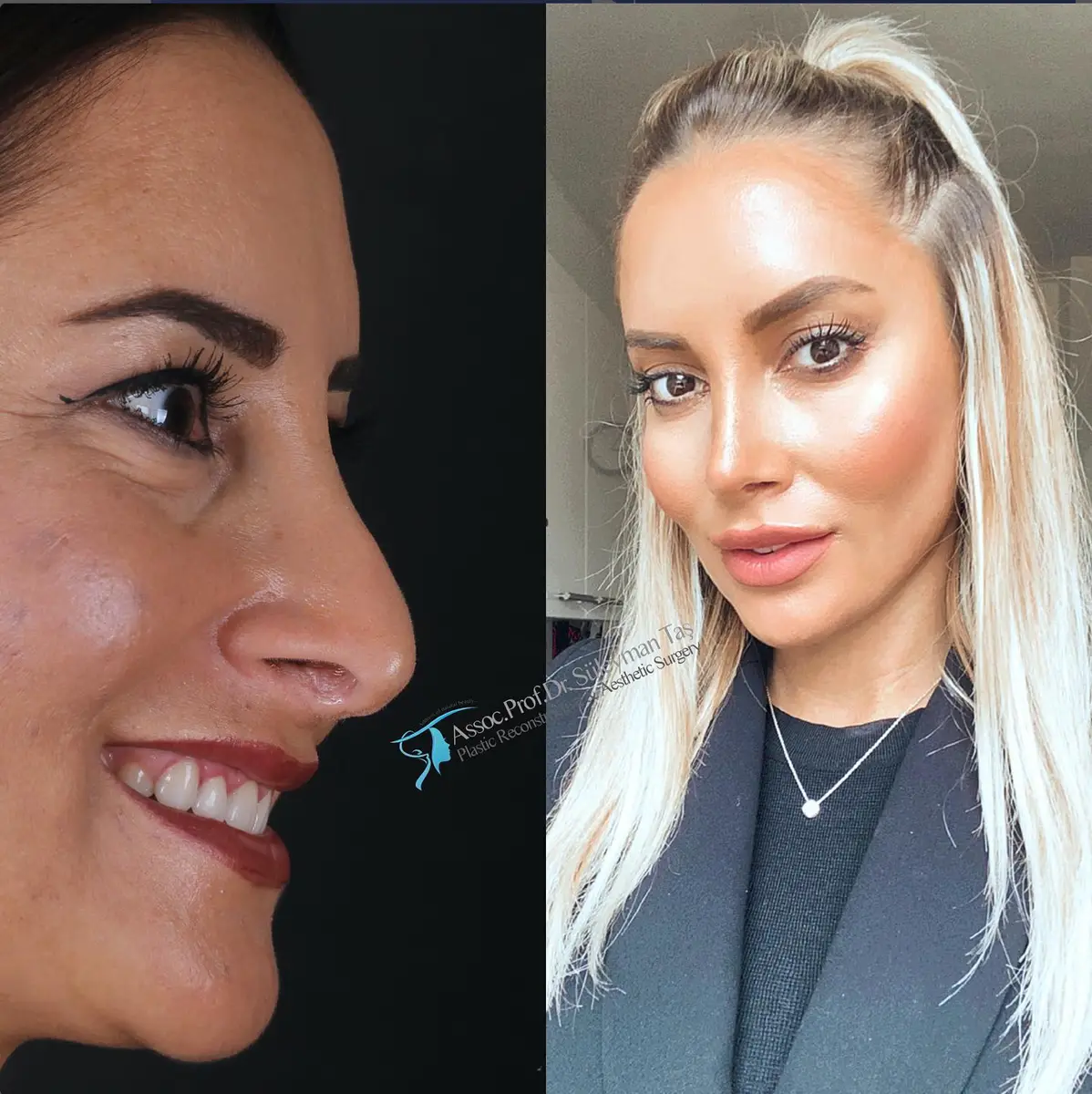 Suleyman Tas reviews – verified rhinoplasty patient review #138 (photo 2)